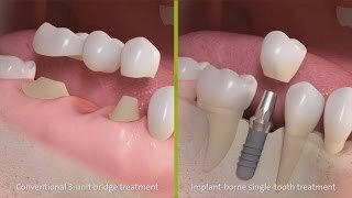 Kroon vs implantaat, wat is beter qua levensduur?