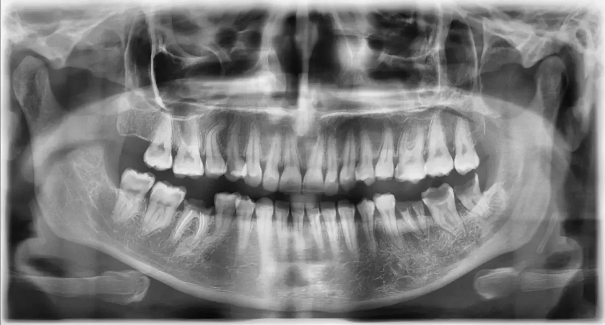 Een grote panoramische foto voor de gebitscontrole. 