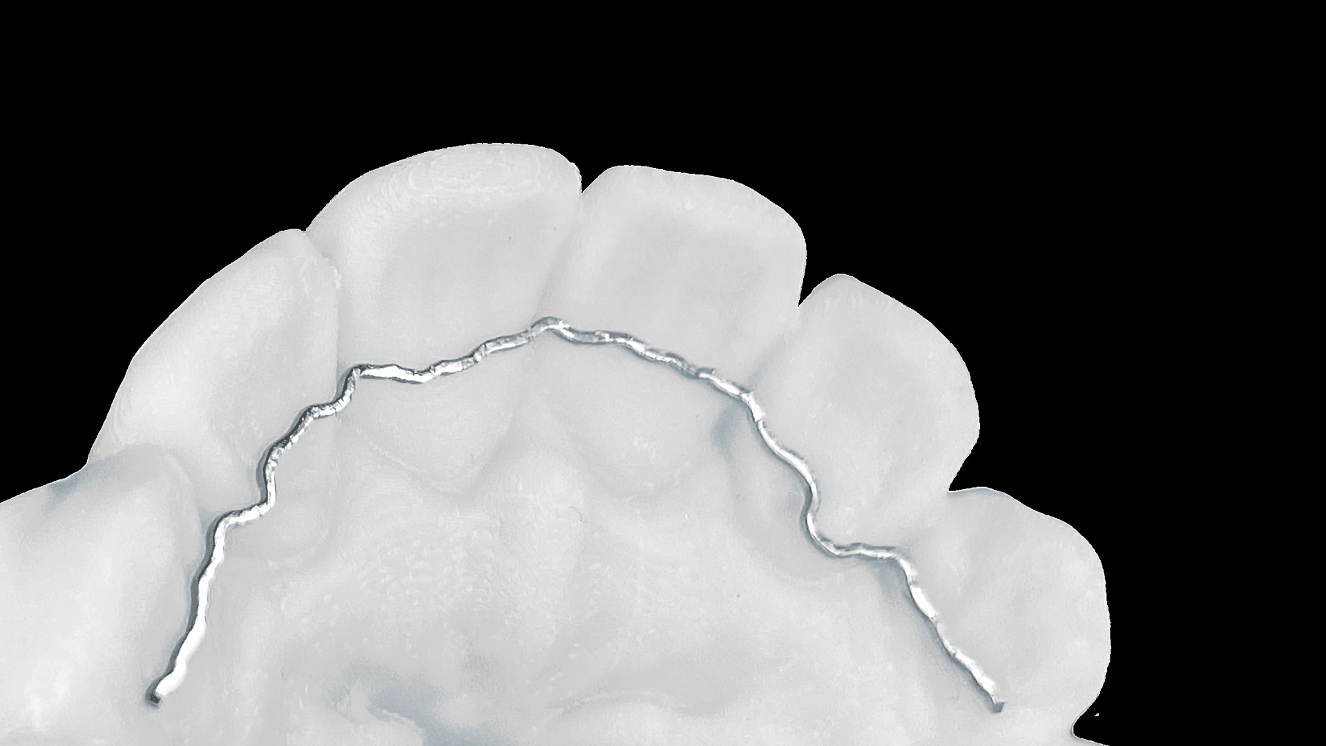 Draad_retainer_vast.webp