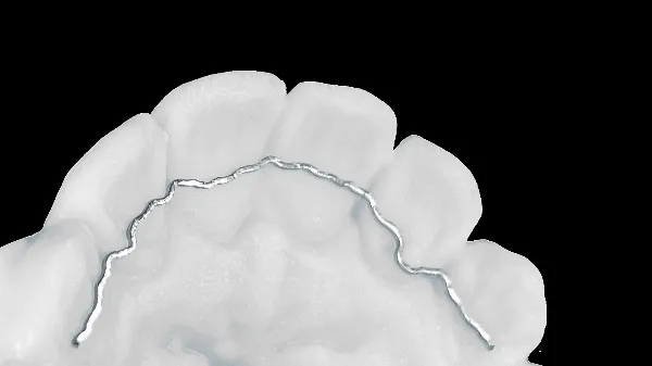 Draad_retainer_vast.webp