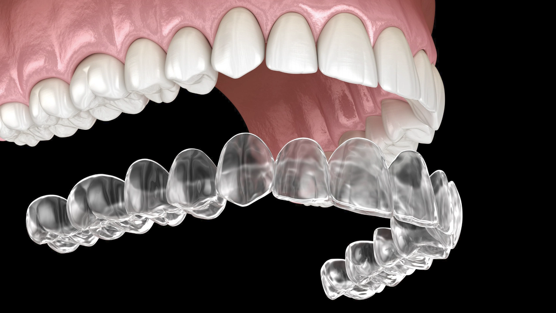 Ortho_aligner_op_kaak.webp