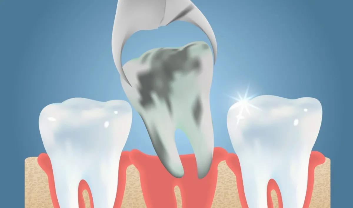 Een extractie, het trekken van een zieke tand of kies.