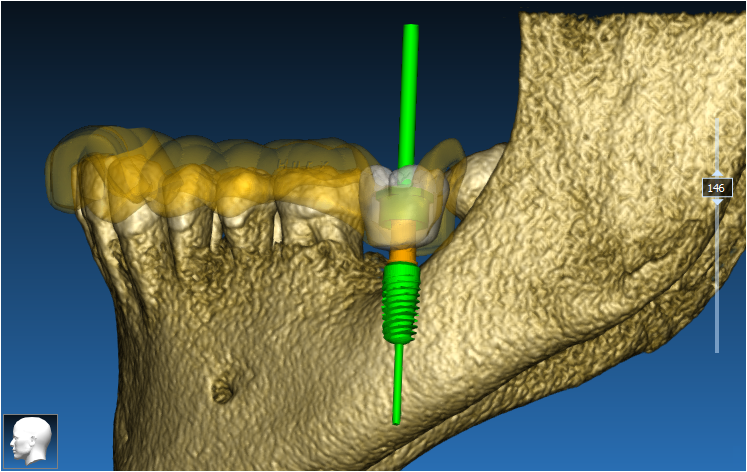 Een plan voor een implantaat