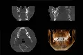 Handige toevoeging aan de praktijk, een tandheelkundige CT scanner