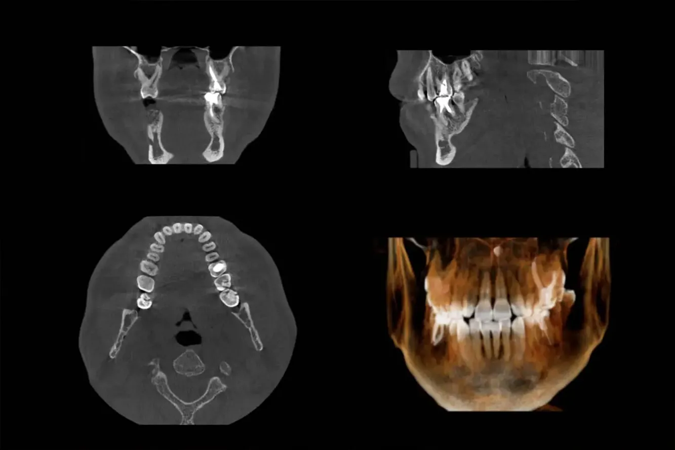 Handige toevoeging aan de praktijk, een tandheelkundige CT scanner